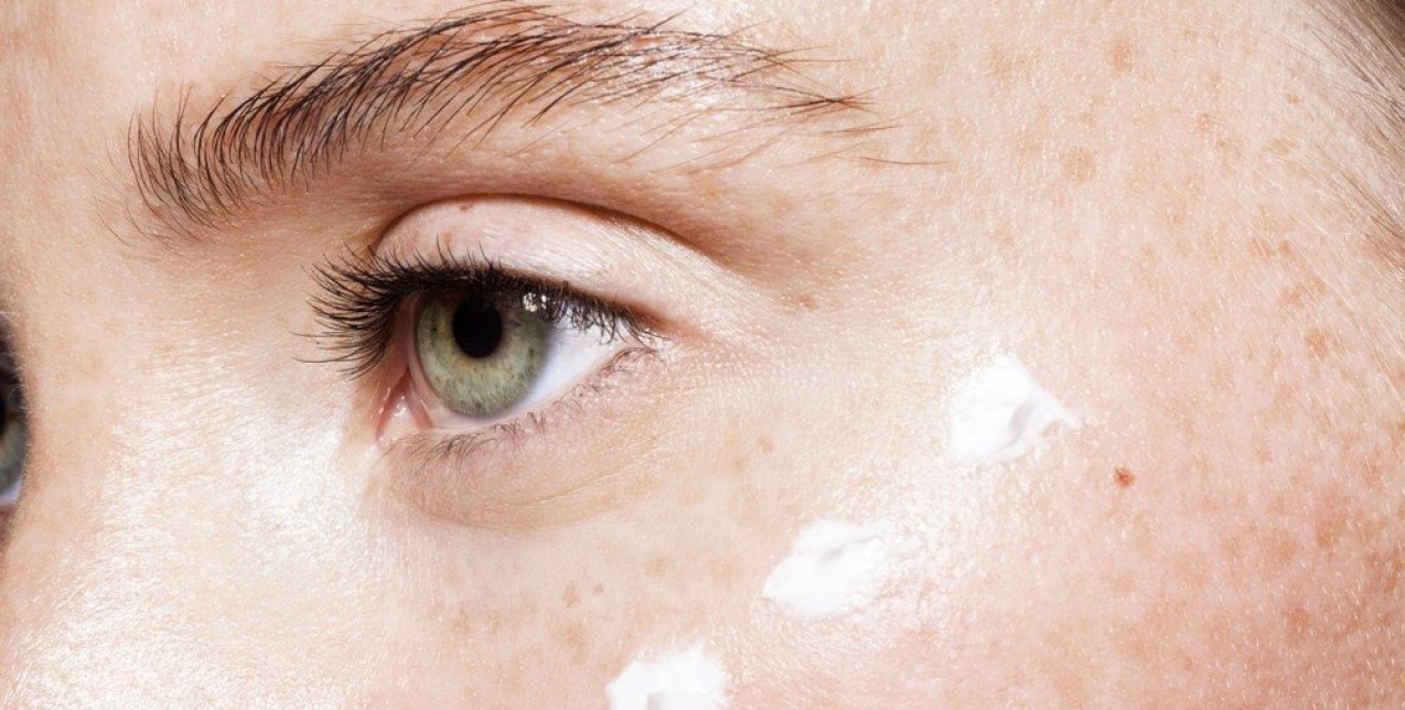 Hyperpigmentation: Τι είναι, πώς εμφανίζεται στο δέρμα και οι τρόποι να το καταπολεμήσετε